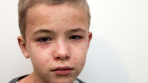 A picture to show symptoms of measles. (Image Credit: Commonwealth of Australia)